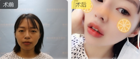 玻尿酸丰唇