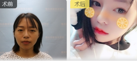 玻尿酸丰唇