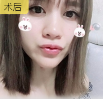 玻尿酸丰唇