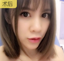 玻尿酸丰唇