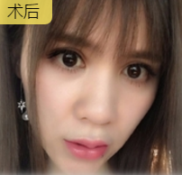 玻尿酸丰唇