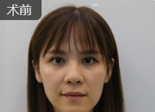 玻尿酸丰唇