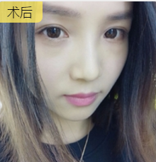 玻尿酸丰唇