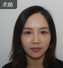 玻尿酸丰唇