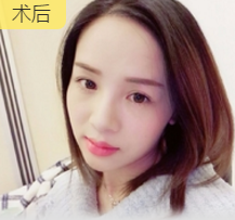 玻尿酸丰唇