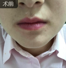 玻尿酸丰唇
