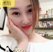 玻尿酸丰唇