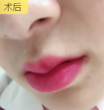 玻尿酸丰唇