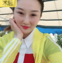 玻尿酸丰唇