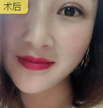 玻尿酸丰唇
