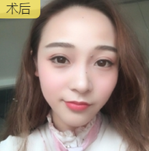 面部提升术