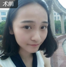 面部提升术