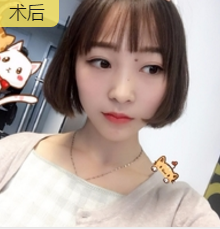 面部提升术