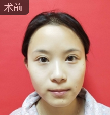 不开刀下巴延长术