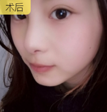 不开刀下巴延长术