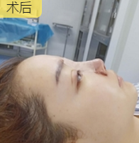 隆鼻手术