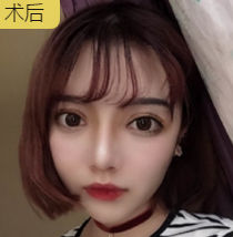 隆鼻手术