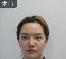 隆鼻手术