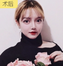 隆鼻手术