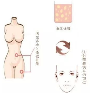 自体脂肪填充术