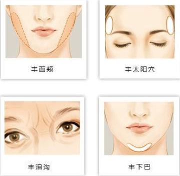 自体脂肪填充术