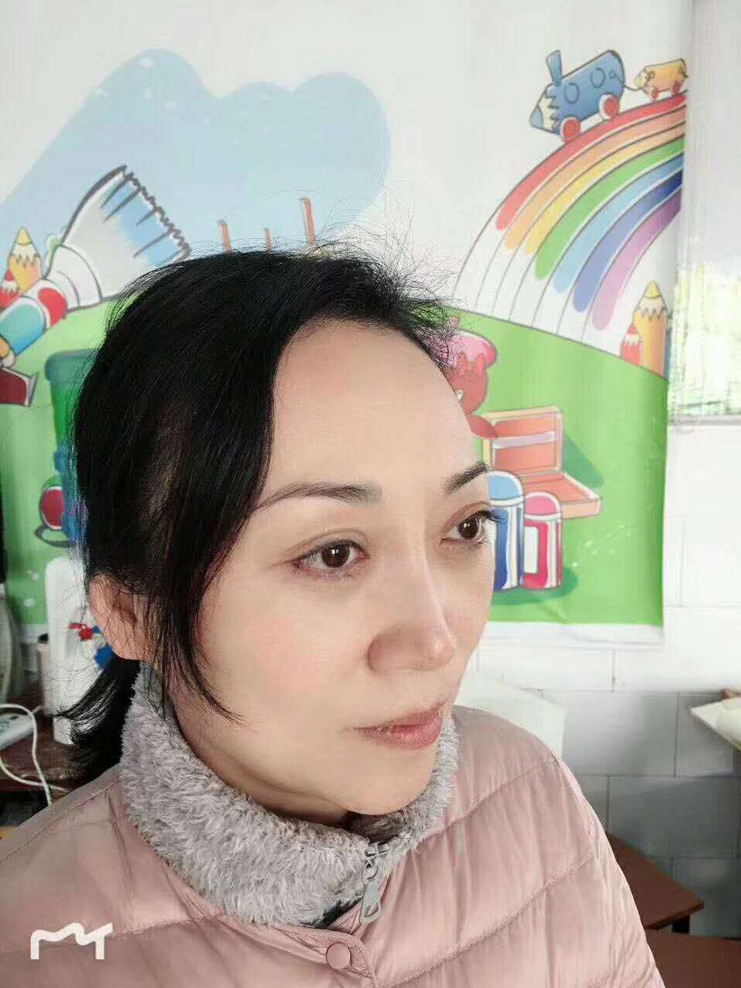 超声波去眼袋