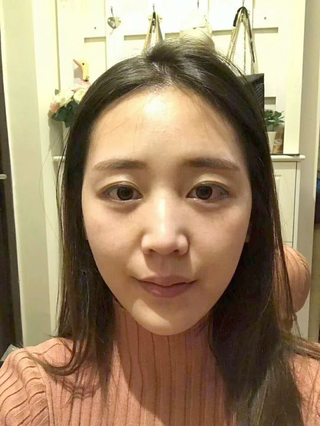 超声波去眼袋