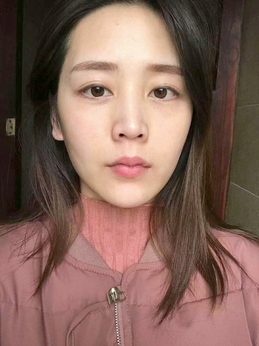 超声波去眼袋