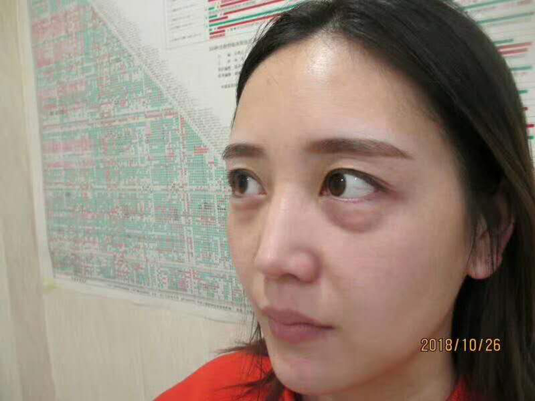 超声波去眼袋