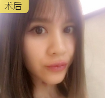 玻尿酸丰唇
