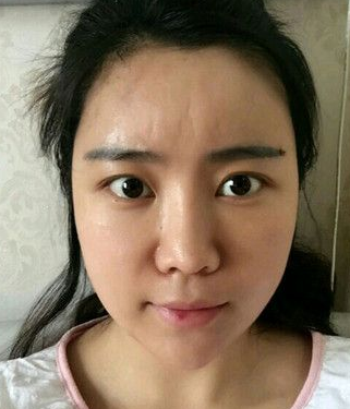 自体脂肪填充术