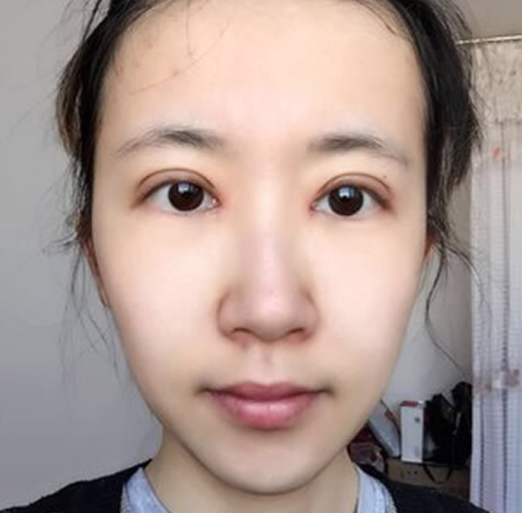 超声波双眼皮