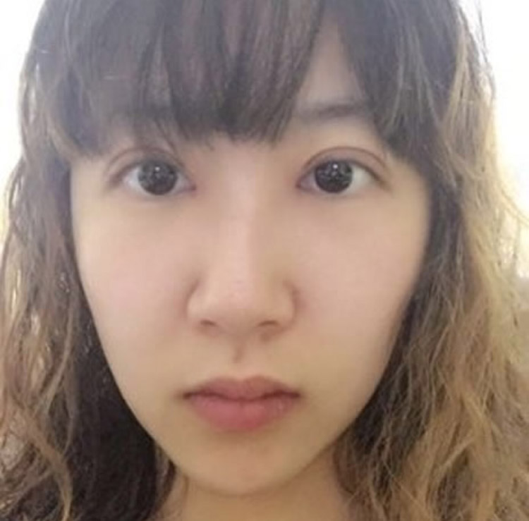 超声波双眼皮