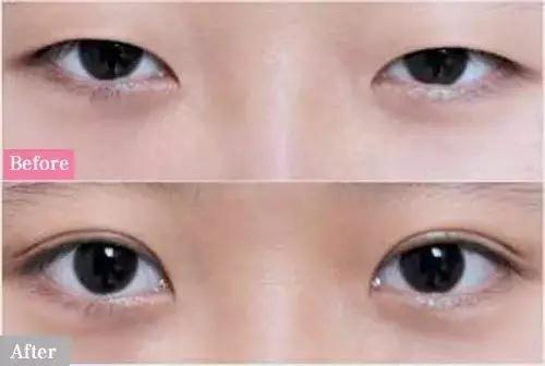 双眼皮手术