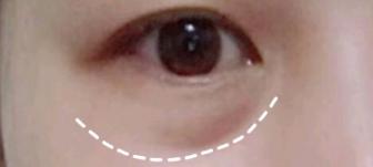 超声波去眼袋