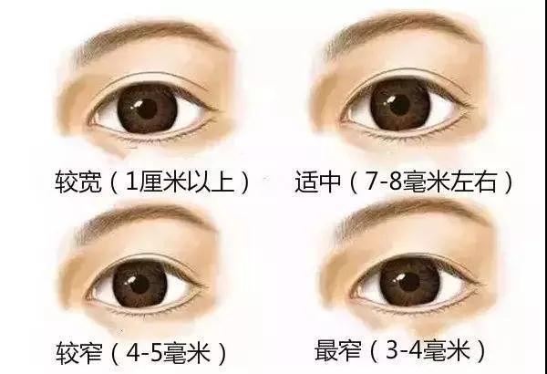 双眼皮手术