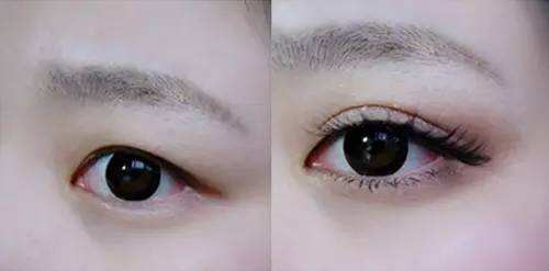双眼皮手术