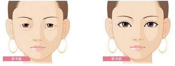 双眼皮手术