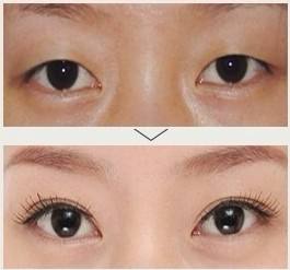 双眼皮手术