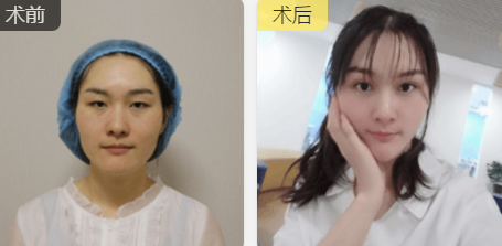 双眼皮手术