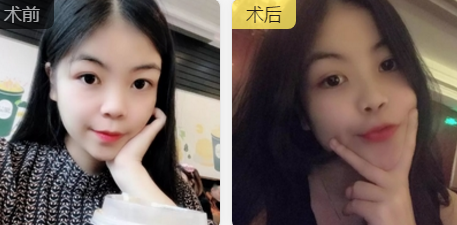 双眼皮手术