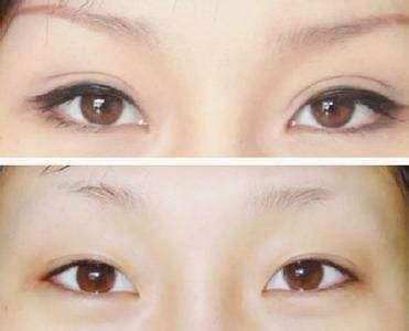 双眼皮手术
