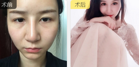 双眼皮手术