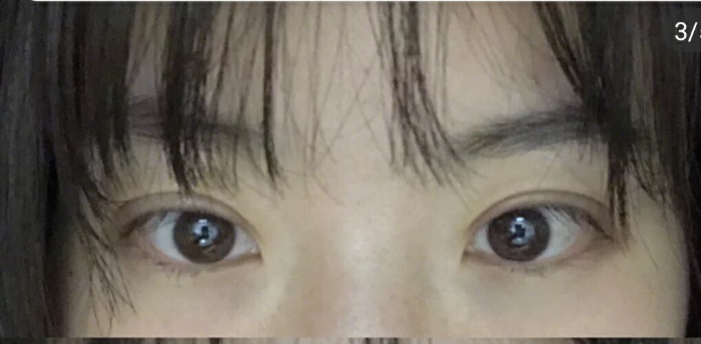 超声波双眼皮