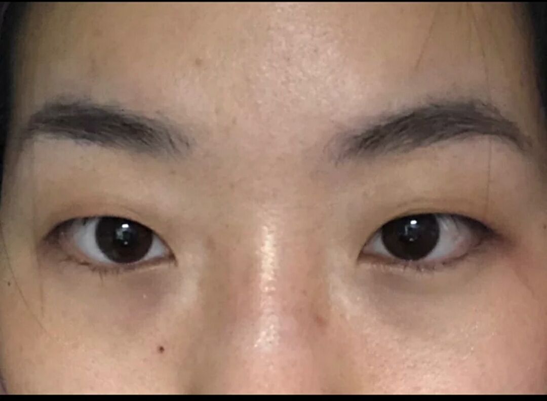超声波双眼皮