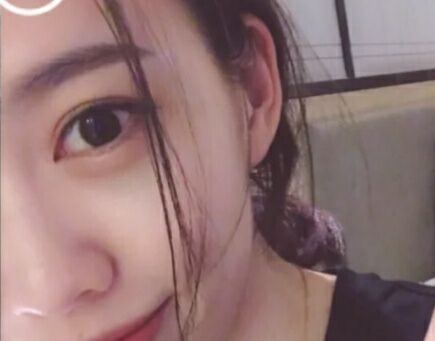 超声波按摩去眼袋