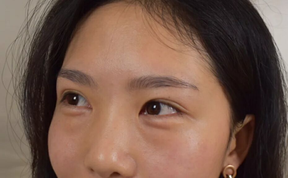 超声波按摩去眼袋