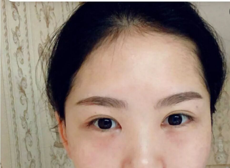 超声波按摩去眼袋