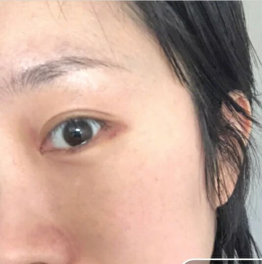 超声波去眼袋