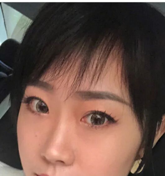 超声波去眼袋